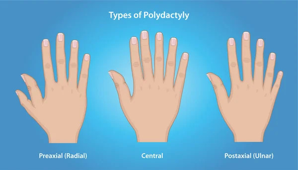Polidaktili